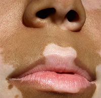 labiovitiligo-195×200