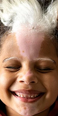 pelovitiligo-1,2-200×400